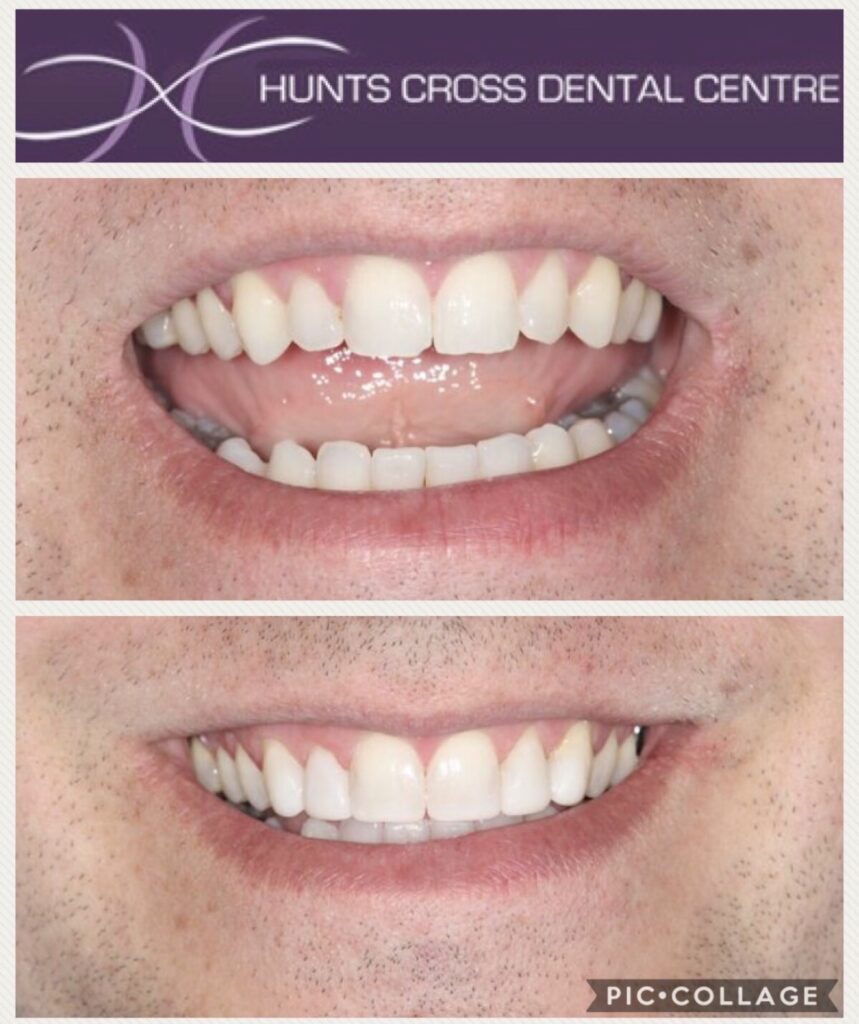 Quick, Straight Teeth With Composite Bonding Hunts Cross Dental